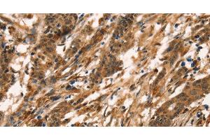 Immunohistochemistry of paraffin-embedded Human gastric cancer tissue using CD159a/c Polyclonal Antibody at dilution 1:30 (CD159a/c antibody)