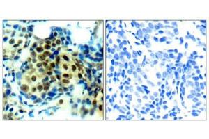 Immunohistochemical analysis of paraffin-embedded human breast carcinoma tissue using p44/42 MAP Kinase (Phospho-Thr202) Antibody (left) or the same antibody preincubated with blocking peptide (right). (ERK1 antibody  (pThr202))