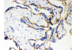Immunohistochemistry (Paraffin-embedded Sections) (IHC (p)) image for anti-Cadherin 1, Type 1, E-Cadherin (Epithelial) (CDH1) (AA 286-703) antibody (ABIN3043808) (E-cadherin antibody  (AA 286-703))
