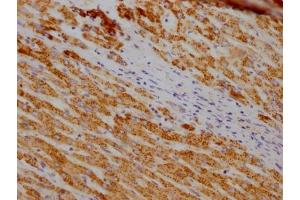 IHC image of ABIN7127818 diluted at 1:100 and staining in paraffin-embedded human liver cancer performed on a Leica BondTM system. (Recombinant SOD2 antibody)