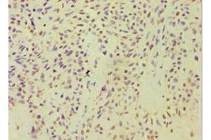 Immunohistochemistry of paraffin-embedded human breast cancer using ABIN7143446 at dilution of 1:100 (ARF3 antibody  (AA 1-181))