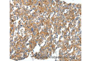 Immunohistochemistry of Human cervical cancer using CXCL12 Polyclonal Antibody at dilution of 1:40