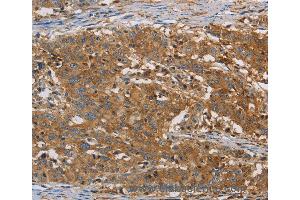 Immunohistochemistry of Human gastic cancer using CFL1 Polyclonal Antibody at dilution of 1:30 (Cofilin antibody)