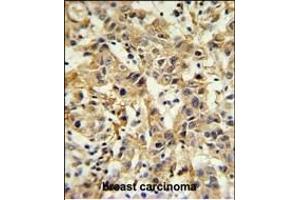 CA6 Antibody (C-term) (ABIN653737 and ABIN2843041) IHC analysis in formalin fixed and paraffin embedded breast carcinoma followed by peroxidase conjugation of the secondary antibody and DAB staining. (CA6 antibody  (C-Term))