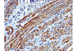 Formalin-fixed, paraffin-embedded human Leiomyosarcoma stained with SM-MHC Mouse Monoclonal Antibody (MYH11/923). (MYH11 antibody)