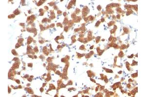 Formalin-fixed, paraffin-embedded human Thyroid Carcinoma stained with Cytokeratin 18 Mouse Monoclonal Antibody (C-04). (Cytokeratin 18 antibody)