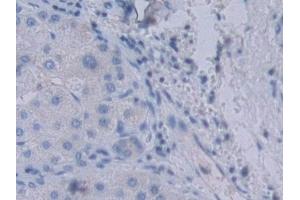 Detection of YARS in Human Liver cancer Tissue using Polyclonal Antibody to Tyrosyl tRNA Synthetase (YARS) (YARS antibody  (AA 2-528))