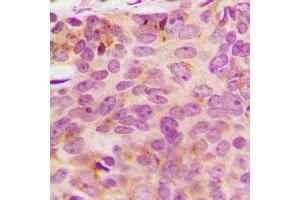 Immunohistochemical analysis of NDUFA3 staining in human breast cancer formalin fixed paraffin embedded tissue section.