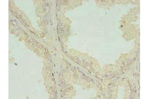 Immunohistochemistry of paraffin-embedded human prostate cancer using ABIN7147106 at dilution of 1:100 (RQCD1 antibody  (AA 1-258))