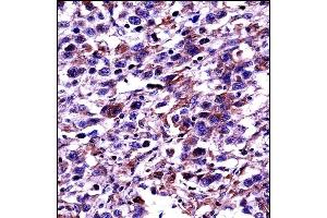 POU2F2 Antibody (N-term) ((ABIN657763 and ABIN2846741))immunohistochemistry analysis in formalin fixed and paraffin embedded human testis carcinoma followed by peroxidase conjugation of the secondary antibody and DAB staining. (Oct-2 antibody  (N-Term))