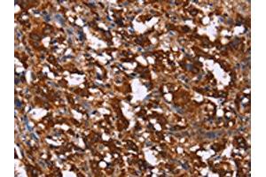 The image on the left is immunohistochemistry of paraffin-embedded Human thyroid cancer tissue using ABIN7190739(GAGE12I Antibody) at dilution 1/20, on the right is treated with synthetic peptide. (G Antigen 12I antibody)