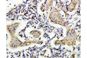 Anti-Caspase-8(P10) antibody, IHC(P) IHC(P): Human Mammary Cancer Tissue (Caspase 8 antibody  (C-Term))