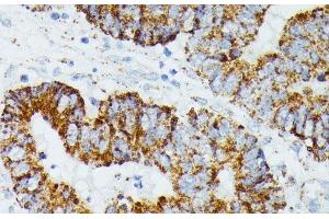 Immunohistochemistry of paraffin-embedded Human colon carcinoma using ETHE1 Polyclonal Antibody at dilution of 1:100 (40x lens). (ETHE1 antibody)