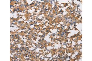 Immunohistochemistry of Human liver cancer using NT5E Polyclonal Antibody at dilution of 1:50 (CD73 antibody)