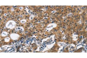 Immunohistochemistry of paraffin-embedded Human gasrtic cancer tissue using DCC Polyclonal Antibody at dilution 1:70 (DCC antibody)