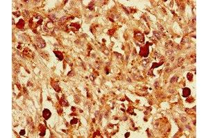Immunohistochemistry of paraffin-embedded human melanoma using ABIN7161441 at dilution of 1:100