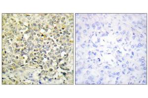 Immunohistochemistry analysis of paraffin-embedded human lung carcinoma tissue using CDKL4 antibody. (CDKL4 antibody  (C-Term))