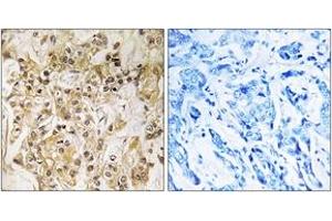 Immunohistochemistry analysis of paraffin-embedded human breast carcinoma tissue, using ZNF295 Antibody.