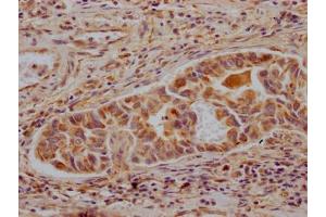 IHC image of ABIN7127333 diluted at 1:100 and staining in paraffin-embedded human liver cancer performed on a Leica BondTM system. (Recombinant ALDH2 antibody)
