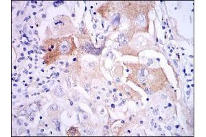 Immunohistochemical analysis of paraffin-embedded lung cancer tissues using IL1B mouse mAb with DAB staining.