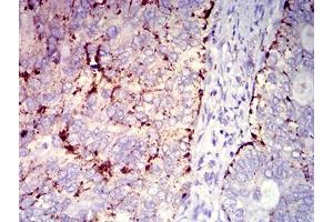 Immunohistochemical analysis of paraffin-embedded cervical cancer tissues using CD182 mouse mAb with DAB staining. (CXCR2 antibody)