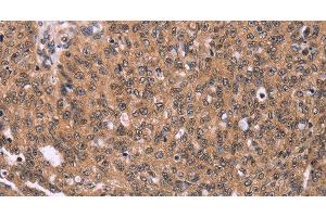 Immunohistochemistry of paraffin-embedded Human ovarian cancer using ERAS Polyclonal Antibody at dilution of 1:40 (ERAS antibody)