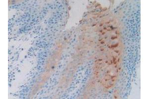 IHC-P analysis of Human Stomach Cancer Tissue, with DAB staining. (PTPRH antibody  (AA 844-1096))