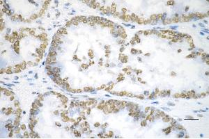 Immunohistochemistry was performed on paraffin-embedded human ovarian carcinoma using heat shock transcription factor 1 antibody (ABIN7798861), 1:200). (Recombinant HSF1 antibody)