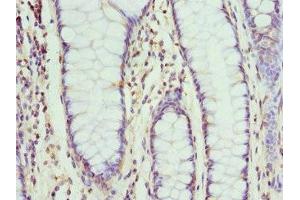 Immunohistochemistry of paraffin-embedded human colon cancer using ABIN7161336 at dilution of 1:100 (Neuromedin U antibody  (AA 35-174))