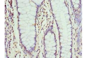 Immunohistochemistry of paraffin-embedded human colon cancer using ABIN7161336 at dilution of 1:100 (Neuromedin U antibody  (AA 35-174))