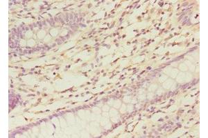 Immunohistochemistry of paraffin-embedded human colon cancer using ABIN7161139 at dilution of 1:100 (COBRA1 antibody  (AA 8-199))