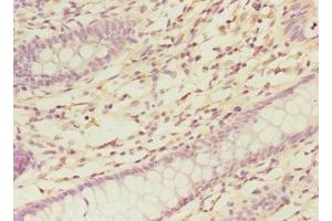 Immunohistochemistry of paraffin-embedded human colon cancer using ABIN7161139 at dilution of 1:100 (COBRA1 antibody  (AA 8-199))