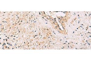 Immunohistochemistry of paraffin-embedded Human prost ate cancer tissue using PCYT2 Polyclonal Antibody at dilution of 1:55(x200)