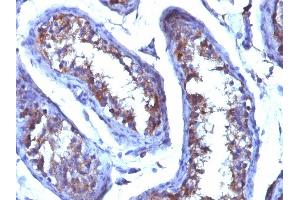 Formalin-fixed, paraffin-embedded human Testicular Carcinoma stained with Testosterone Mouse Monoclonal Antibody (4E1G2). (Testosterone antibody)