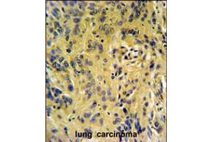 TESC Antibody IHC analysis in formalin fixed and paraffin embedded human lung carcinoma followed by peroxidase conjugation of the secondary antibody and DAB staining. (Tescalcin antibody  (C-Term))