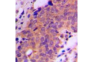 Immunohistochemical analysis of USP19 staining in human breast cancer formalin fixed paraffin embedded tissue section. (USP19 antibody  (Center))