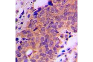 Immunohistochemical analysis of USP19 staining in human breast cancer formalin fixed paraffin embedded tissue section.
