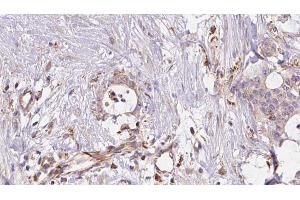 ABIN6273043 at 1/100 staining Human liver cancer tissue by IHC-P. (ERO1LB antibody  (Internal Region))
