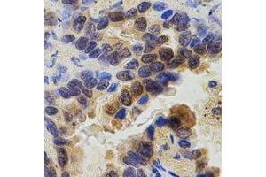 Immunohistochemical analysis of ZAP70 staining in human lung cancer formalin fixed paraffin embedded tissue section. (ZAP70 antibody  (C-Term))