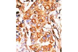 Formalin-fixed and paraffin-embedded human cancer tissue reacted with the primary antibody, which was peroxidase-conjugated to the secondary antibody, followed by AEC staining. (GK2 antibody  (C-Term))