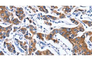 Immunohistochemistry of paraffin-embedded Human breast cancer tissue using MYH1 Polyclonal Antibody at dilution 1:40