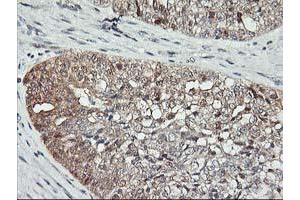 Immunohistochemical staining of paraffin-embedded Adenocarcinoma of Human ovary tissue using anti-ASCC1 mouse monoclonal antibody. (ASCC1 antibody)