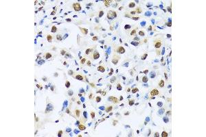 Immunohistochemistry of paraffin-embedded human lung cancer using OTP antibody (ABIN6132447, ABIN6145083, ABIN6145084 and ABIN6217092) at dilution of 1:100 (40x lens). (OTP antibody  (AA 1-130))