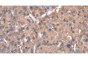 Immunohistochemistry of paraffin-embedded Human liver cancer tissue using SPAST Polyclonal Antibody at dilution 1:40 (Spastin antibody)