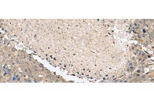 Immunohistochemistry of paraffin-embedded Human liver cancer tissue using KCTD7 Polyclonal Antibody at dilution of 1:55(x200)