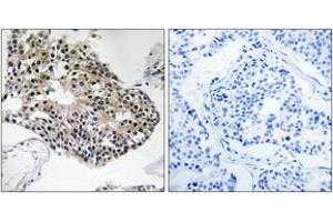 Immunohistochemistry analysis of paraffin-embedded human breast carcinoma tissue, using RPS25 Antibody. (RPS25 antibody  (AA 76-125))