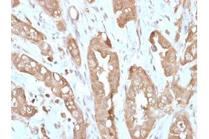 Formalin-fixed, paraffin-embedded human Small Intestine stained with Villin Rabbit Recombinant Monoclonal Antibody (VIL1/2310R). (Recombinant Villin 1 antibody  (AA 179-311))