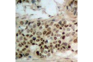 Immunohistochemical analysis of WWOX (pY33) staining in human breast cancer formalin fixed paraffin embedded tissue section. (WWOX antibody  (N-Term, pTyr33))