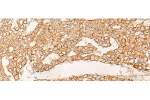 Immunohistochemistry of paraffin-embedded Human liver cancer tissue using KRT9 Polyclonal Antibody at dilution of 1:30(x200) (KRT9 antibody)