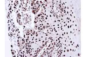 IHC-P Image Immunohistochemical analysis of paraffin-embedded CA922 xenograft, using PSME3, antibody at 1:100 dilution. (PSME3 antibody)